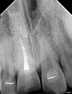 post-op radiograph of a dental trauma case
